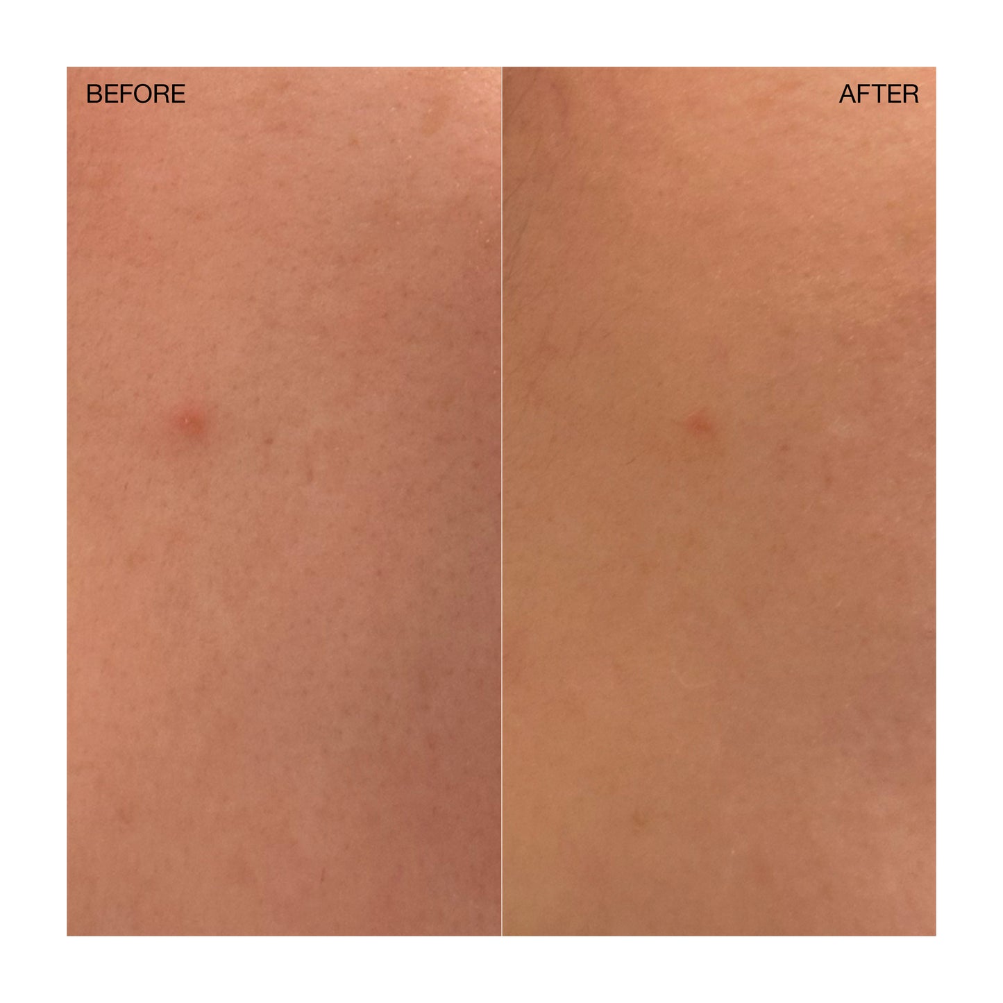 Targeted Blemish Treatment