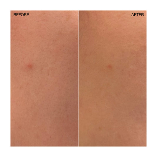 Targeted Blemish Treatment